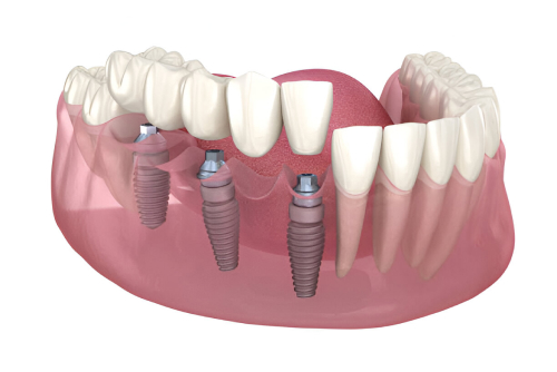 dental crowns and bridges in millwoods