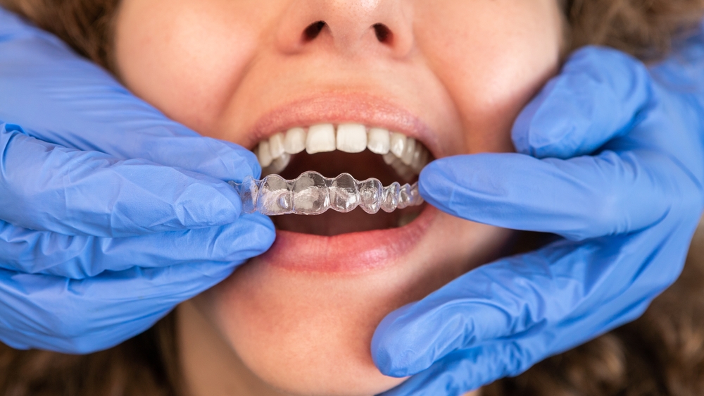 Invisalign service