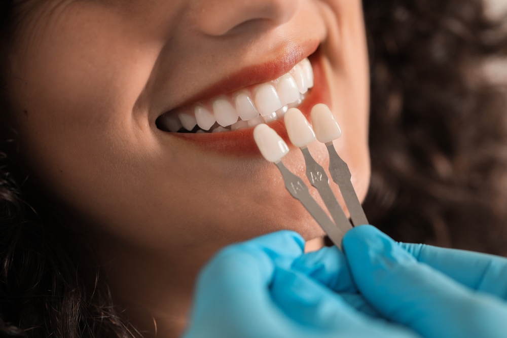 dental veneers edmonton
