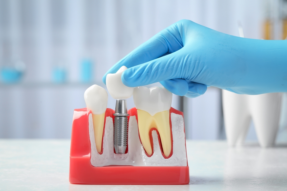 dental crowns protection