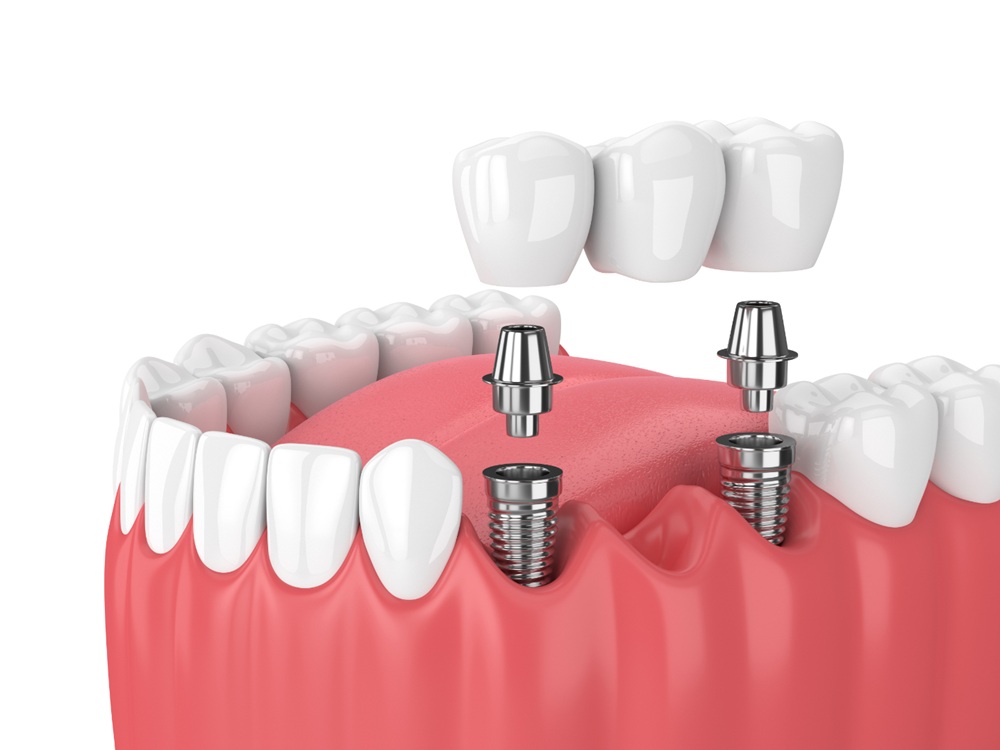 Dental Implants: Risks and Prevention
